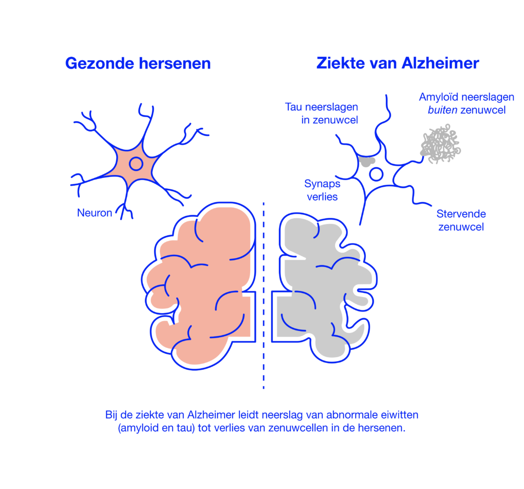 De Oorzaken Van Dementie Ziekte Van Alzheimer PEMPAW